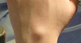WT: Ganglion cyst WT: Ganglion cyst